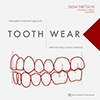 Tooth Wear: Interceptive treatment approach with minimally invasive protocols